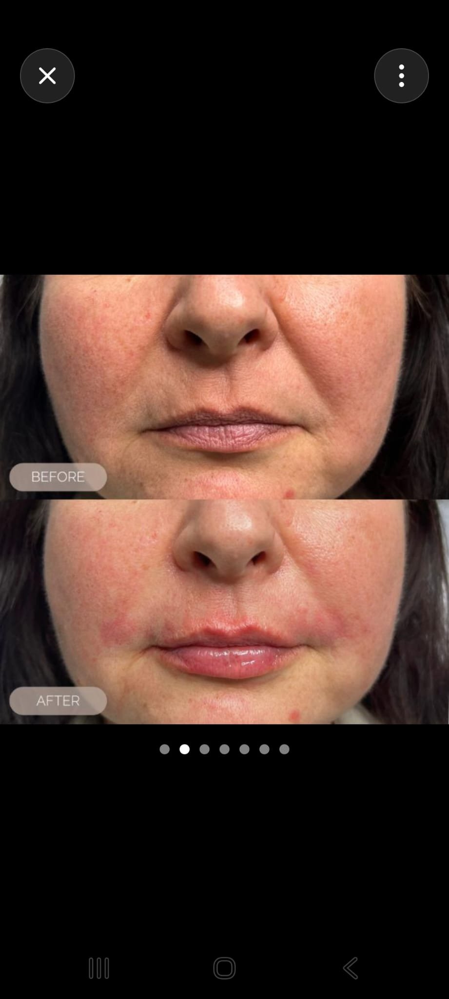 Lip Transformation